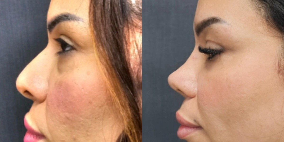 Discover Why Thousands Choose Turkey for Rhinoplasty Each Year