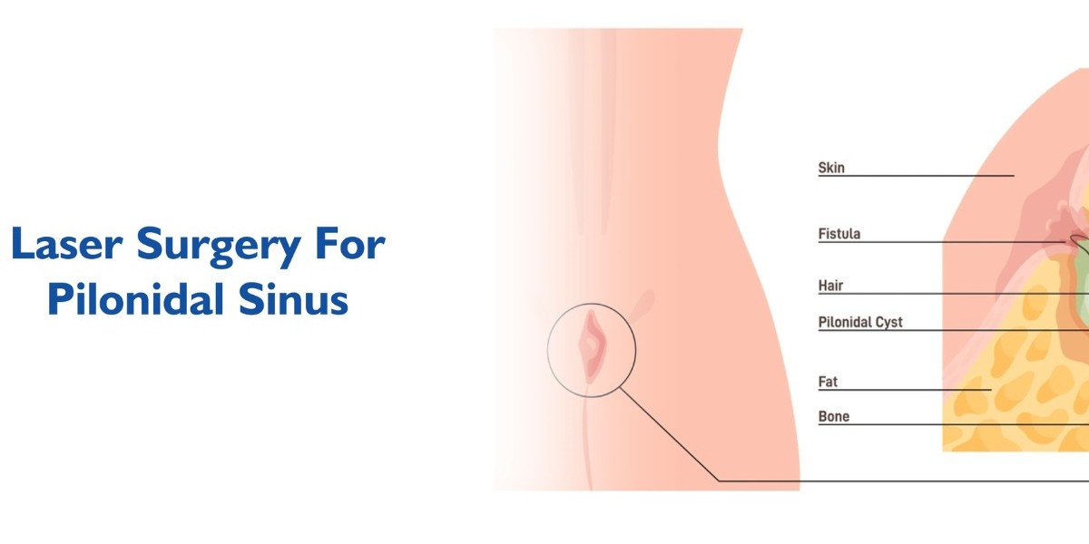 Essential Tips for Pilonidal Sinus Recovery