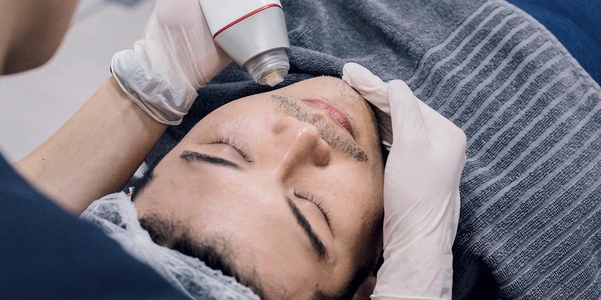 How Fractional RF Microneedling Improves Skin Resilience and Overall Glow