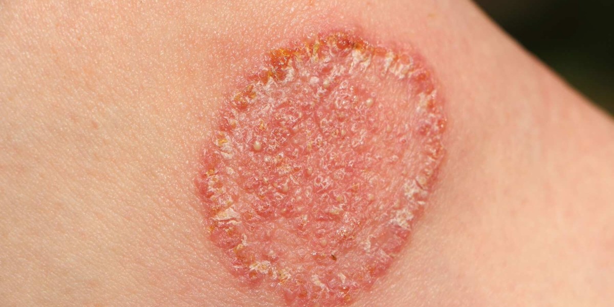Understanding Fungal Infections: Causes, Prevention, and the Rise of Natural Remedies
