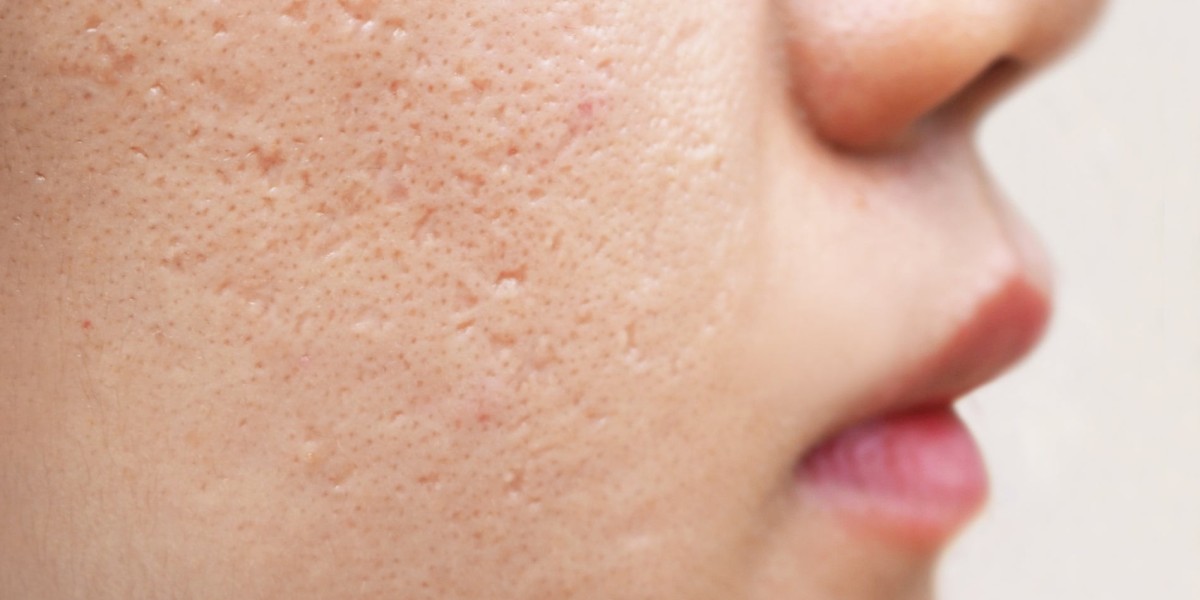 How Effective Are Modern Treatments for Deep Acne Scars?