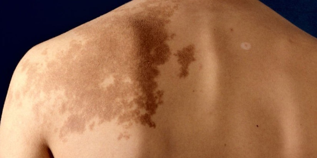 How Many Treatments Are Required to Remove a Birthmark?