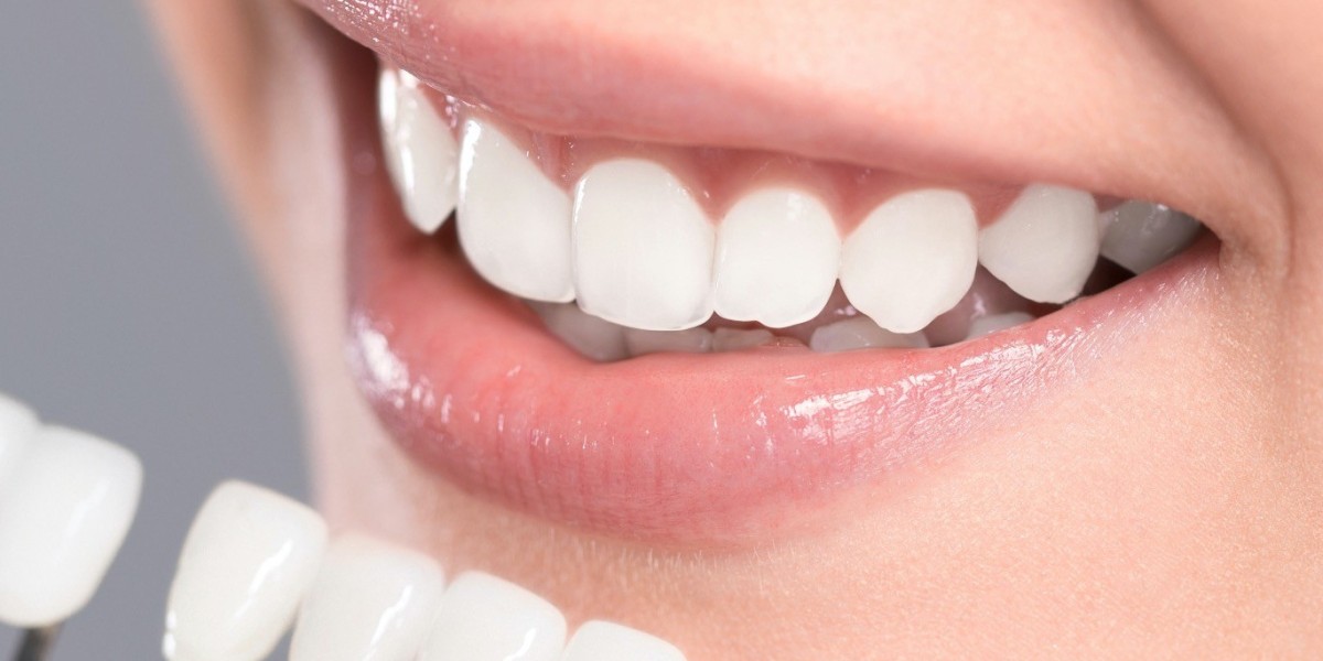 Dental Veneers in Islamabad: Before and After Results