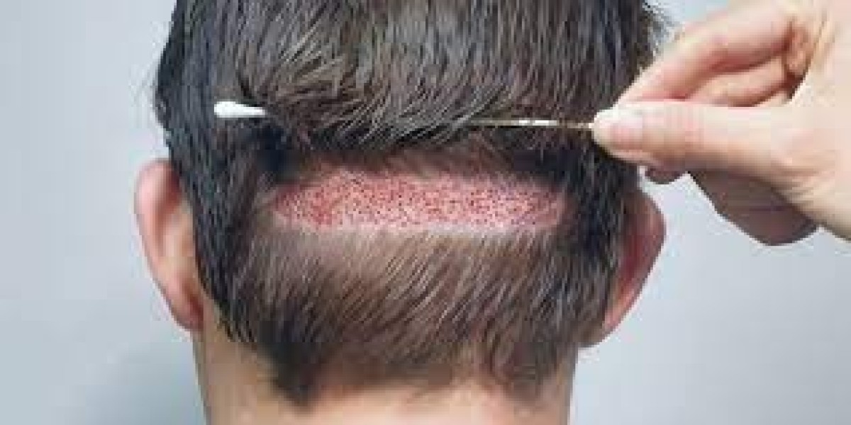 How Is FUT Hair Transplant Different from FUE?