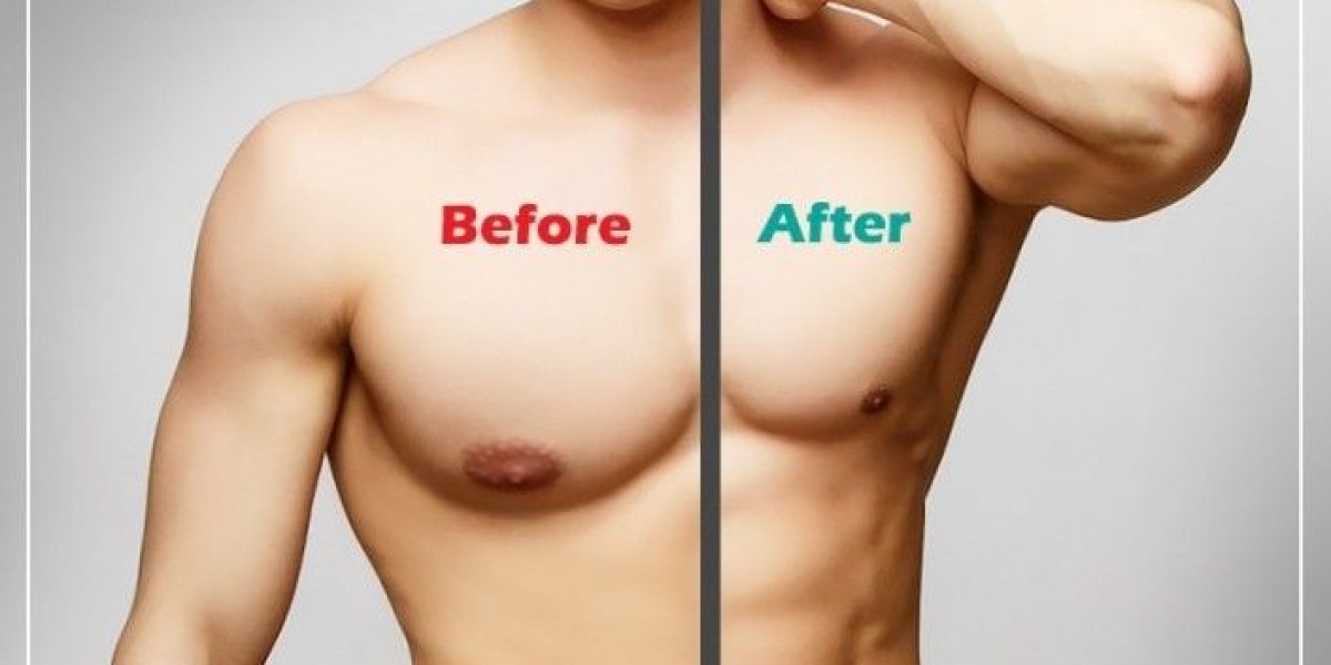 Transform Your Chest with Gynaecomastia Surgery in Dubai