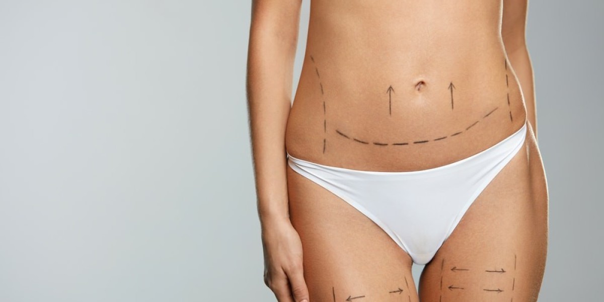 Real Results and Recovery Tips from BodyTite Liposuction Patients