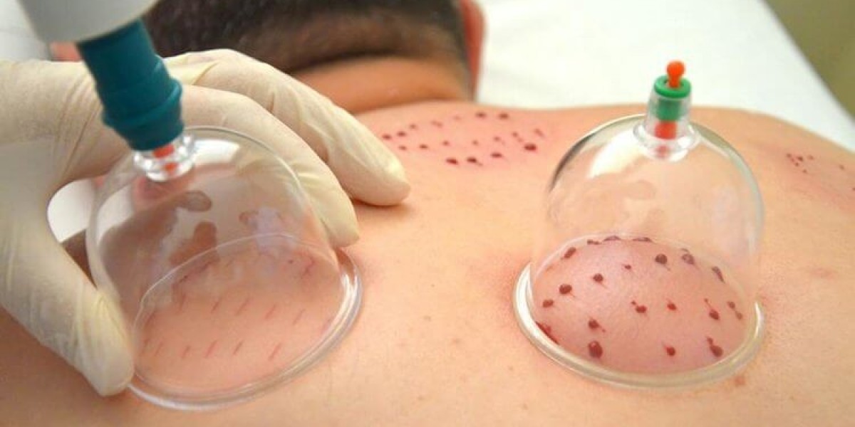 Feel the Flow of Energy with Hijama Cupping Therapy
