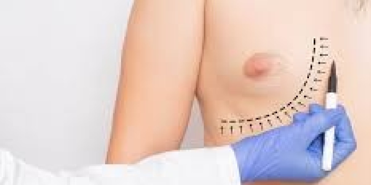 Achieve a Masculine Chest with Gynaecomastia Surgery in Dubai