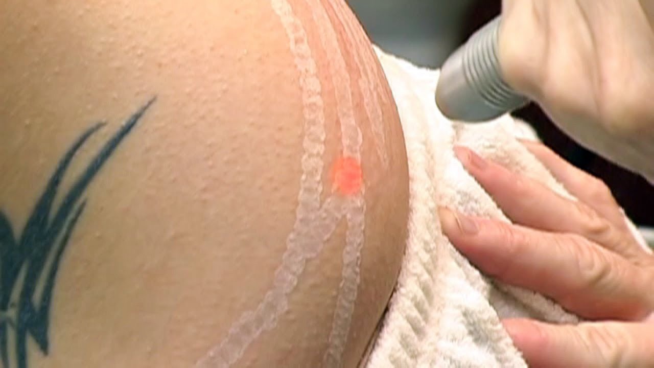 Laser Stretch Marks Treatment