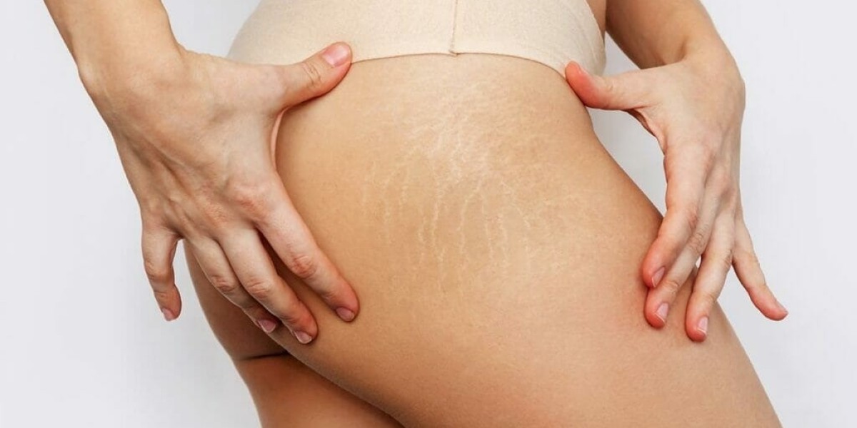 Should I Get Laser Stretch Marks Treatment in Dubai?