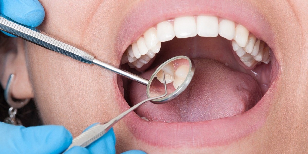 Where to Check Tooth Extraction Cost in Dubai?