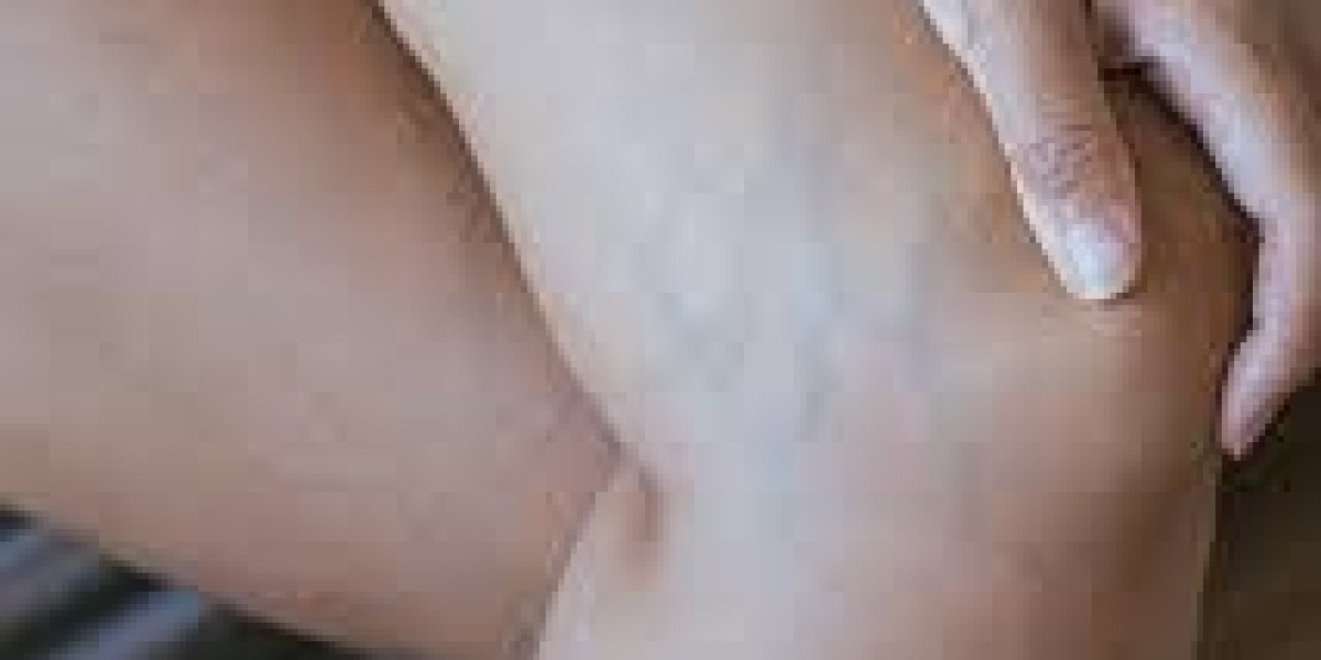 Thinking About Varicose Veins Treatment in India? Let's Talk