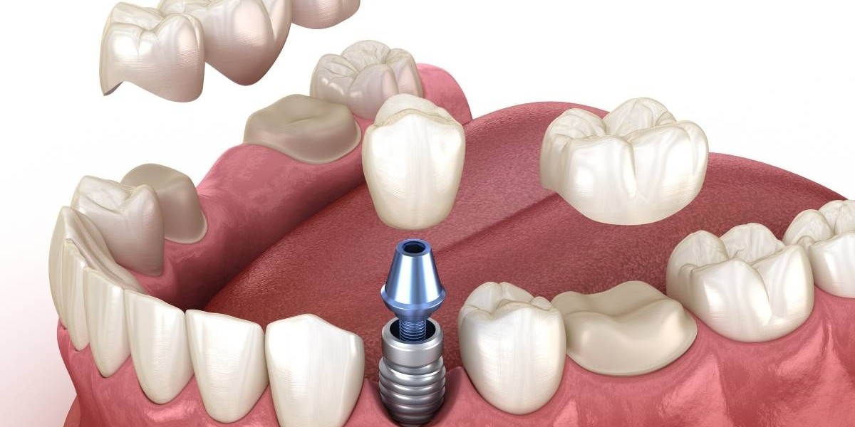 Improve Chewing with Dental Crowns and Bridges