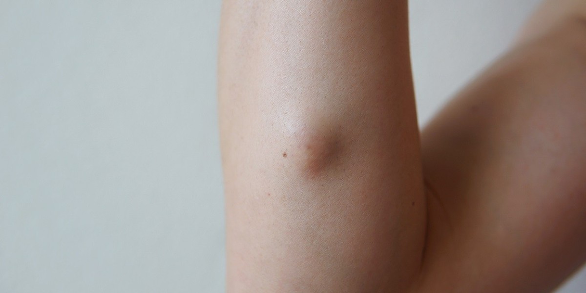 Lipoma Treatment in Dubai: Affordable, Safe, and Revolutionary!