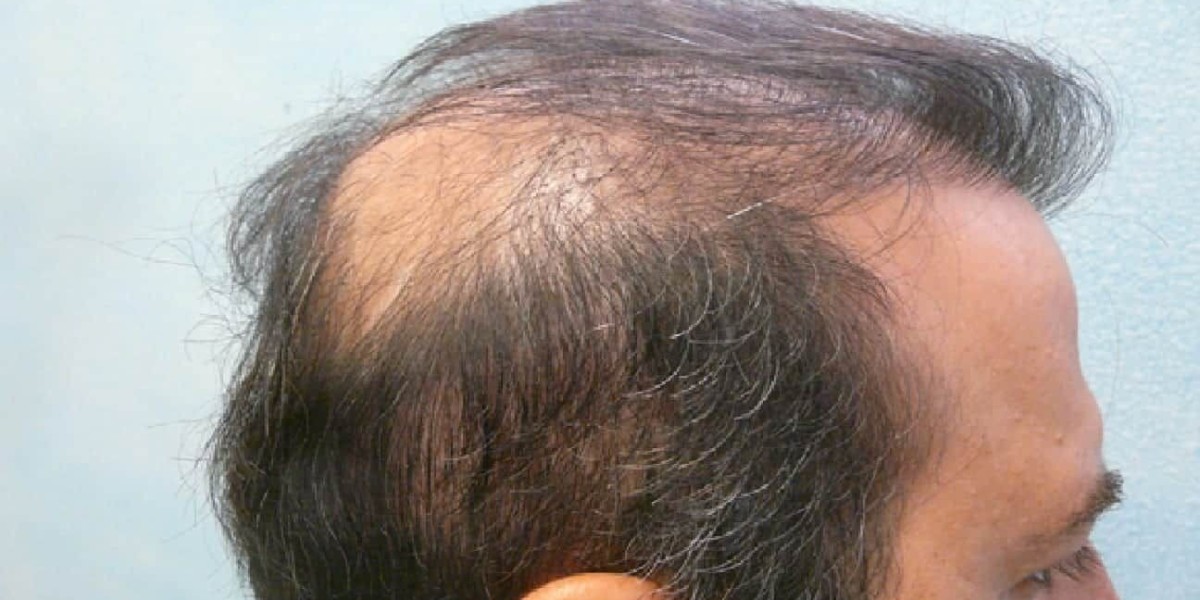How long does a crown hair transplant take to heal?