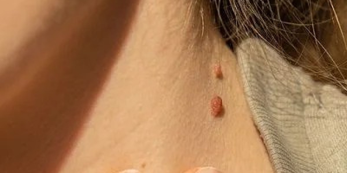How Is Skin Tag Removal Performed by Experts?