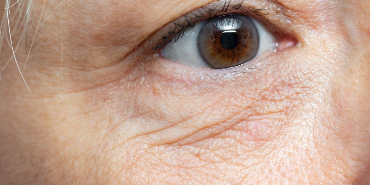 Can HIFU Help Diminish Fine Lines and Wrinkles Around the Eyes?
