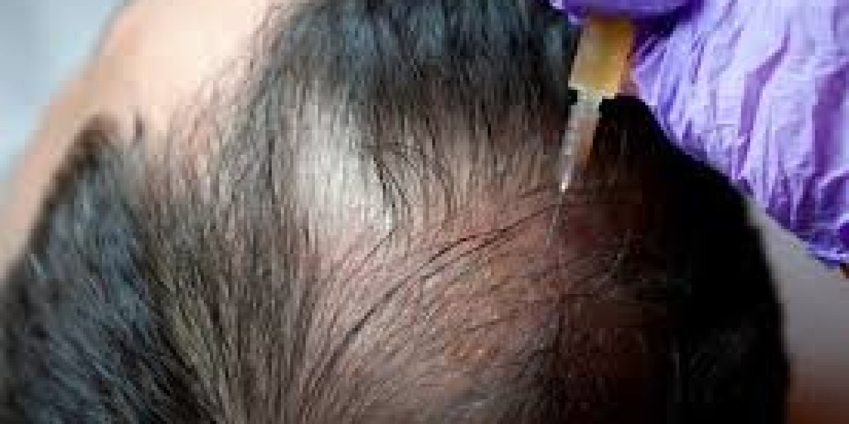 How many ml of PRP and Acell are used per session in Dubai UAE At Glamorous Clinic ?