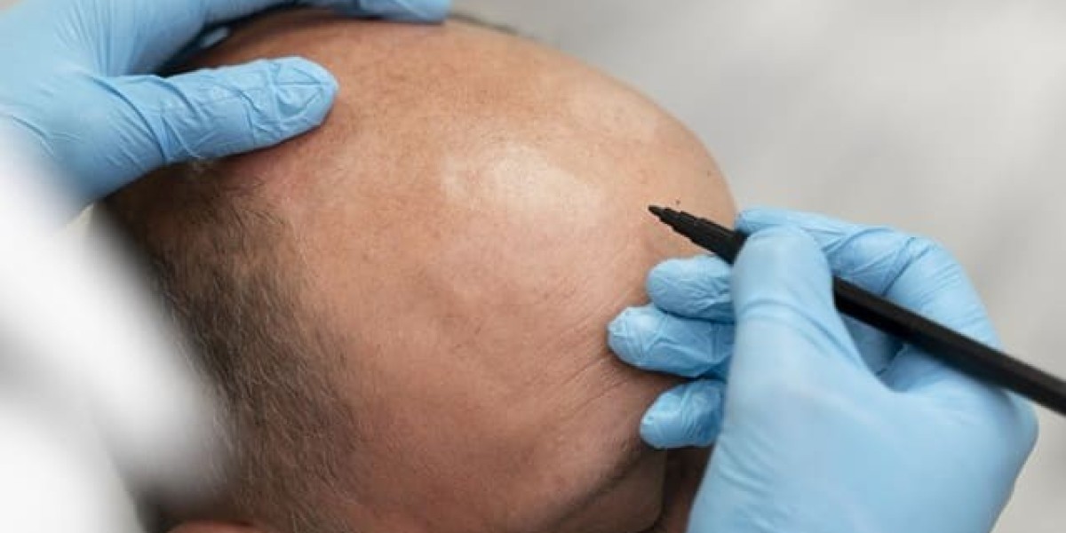 How Does FUT Hair Transplant Differ from FUE?