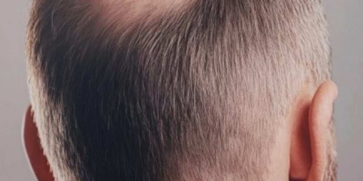 How Many Grafts Are Needed for a Crown Hair Transplant?