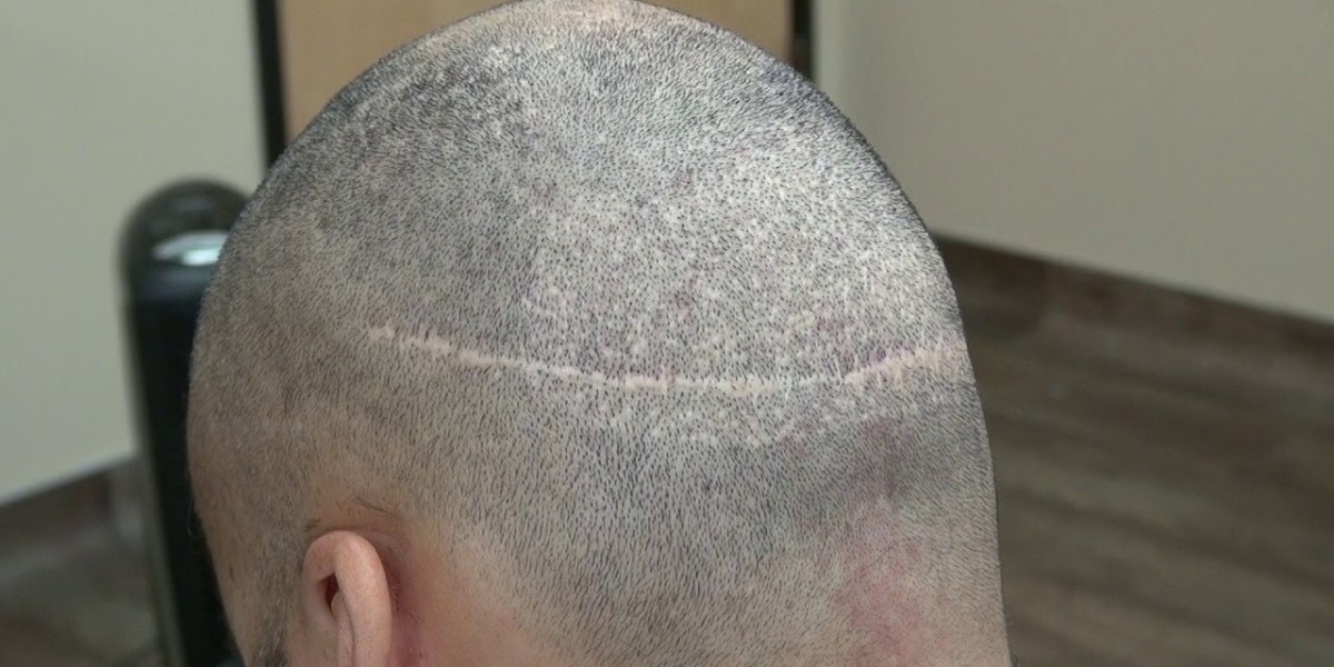 Is FUT Hair Transplant safe and pain-free for patients?