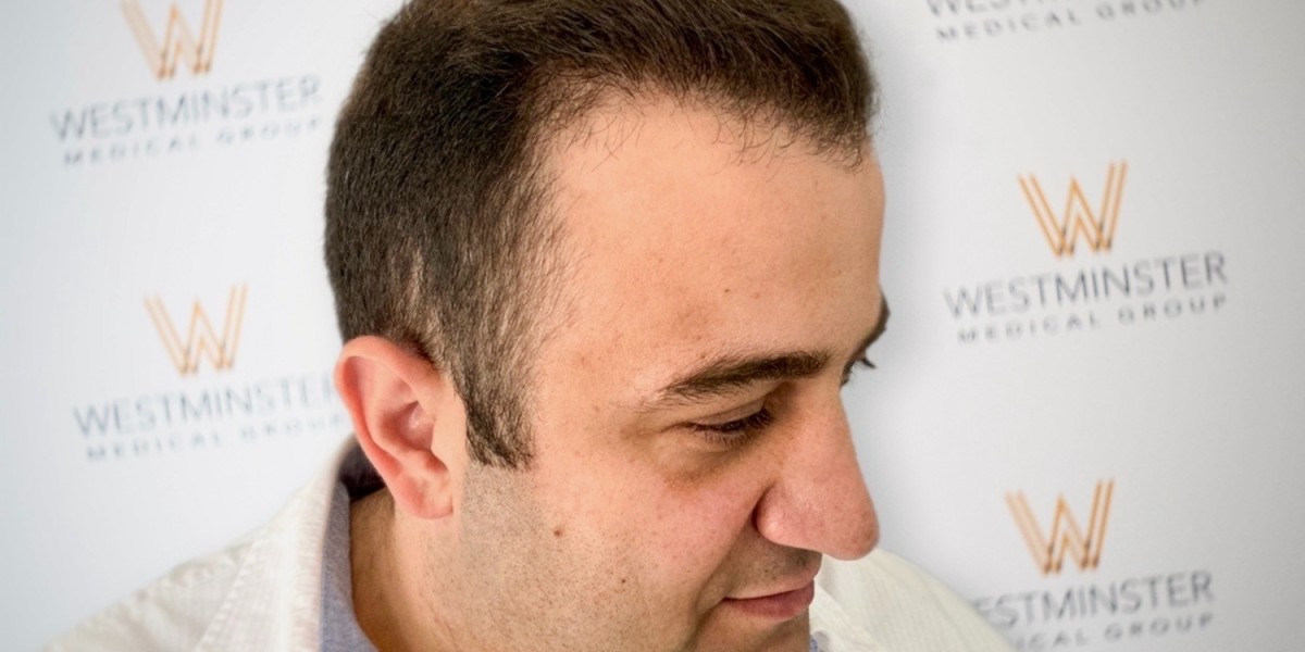 How Westminster Medical Group Helps You Understand Hair Transplant Cost London