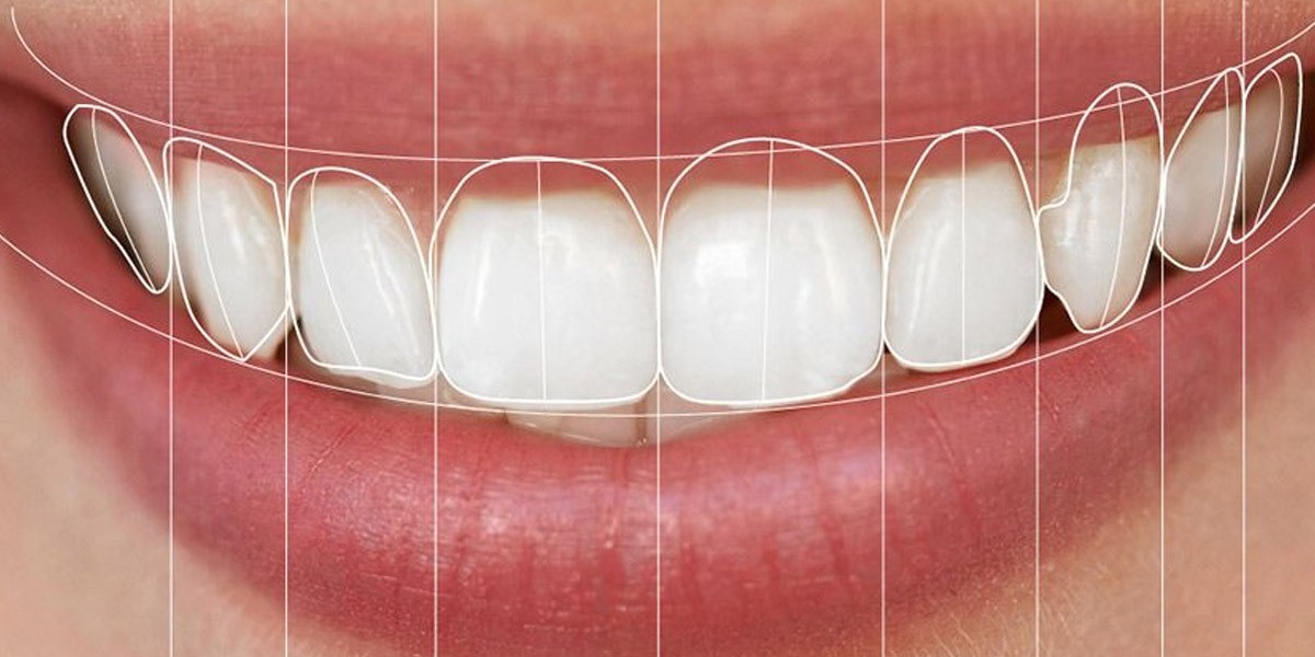 The Step-by-Step Process of Creating a Perfect Smile Using Digital Smile Design