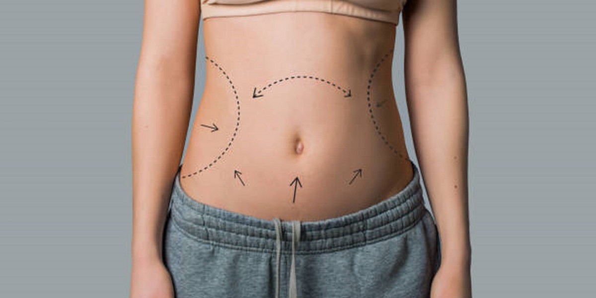 Liposuction Surgery in Riyadh: Procedures, Costs, and Clinics