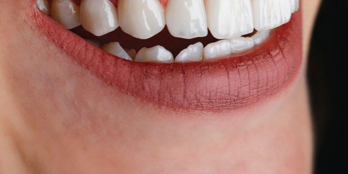 Shine Brighter Every Day with Professionally Crafted Composite Veneers
