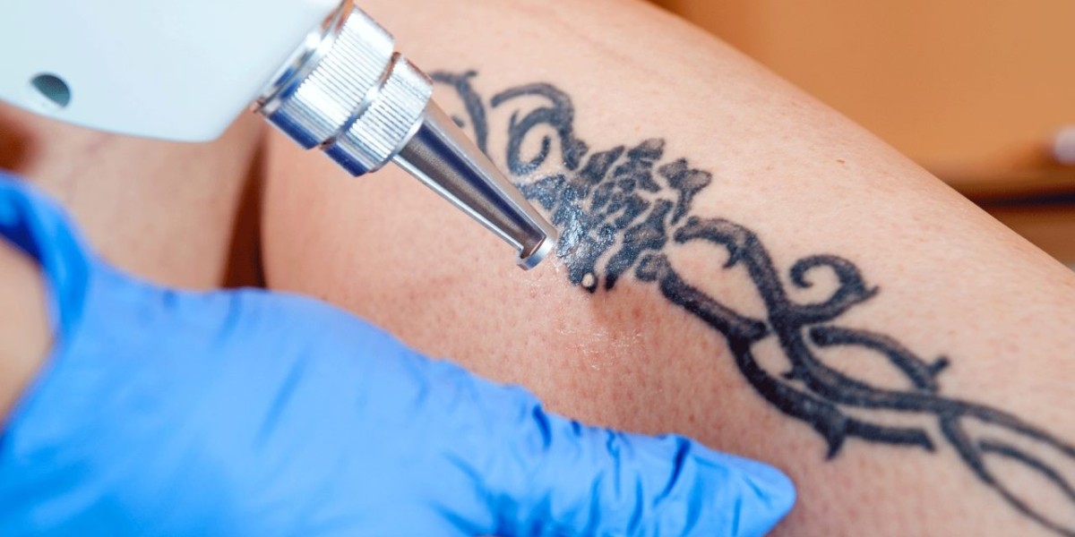 How Many Sessions Are Needed for PicoSure Tattoo Removal?