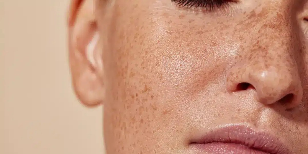 Does Pigmentation Treatment Help Restore Sun-Damaged Skin?