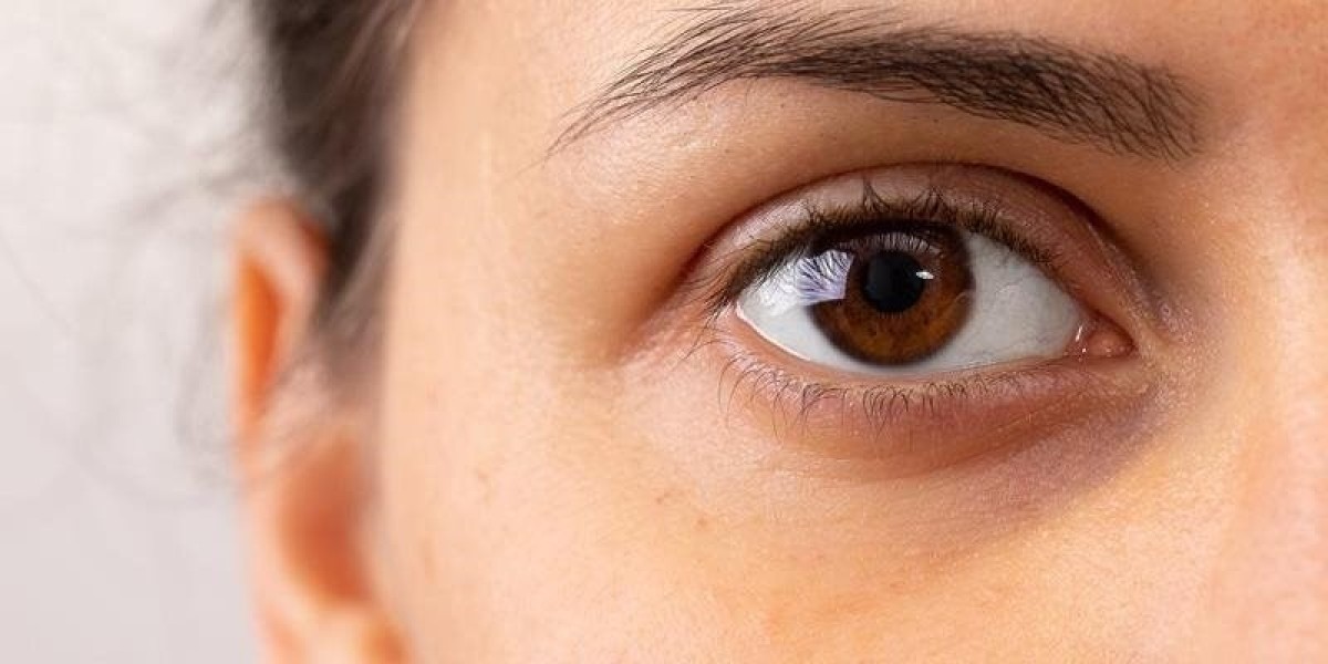 How do dermatologists treat dark circles under eyes?