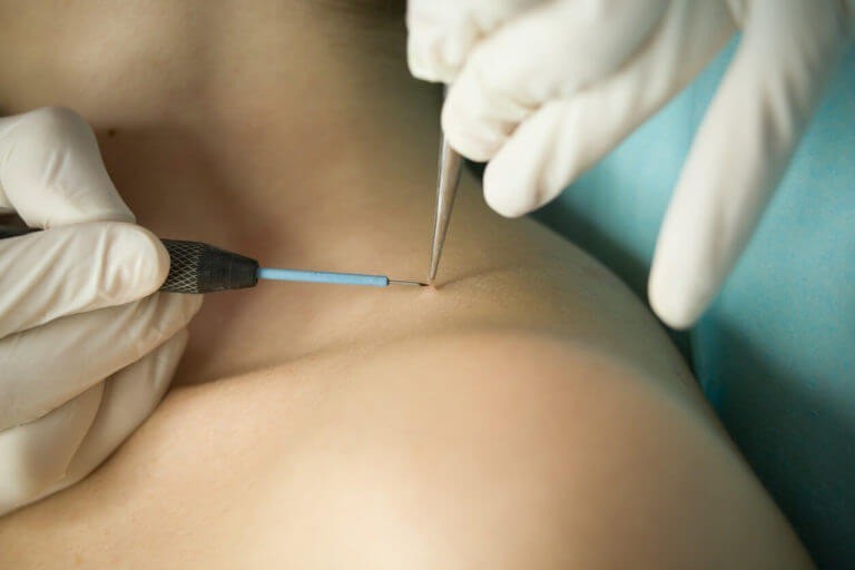 Skin Wart Removal