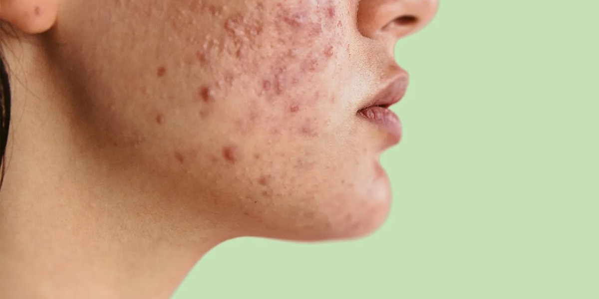 Which Pimples Treatment Is Suitable for Darker Skin Tones?