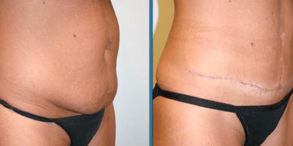 Expert Surgeons Performing Abdominoplasty in Islamabad