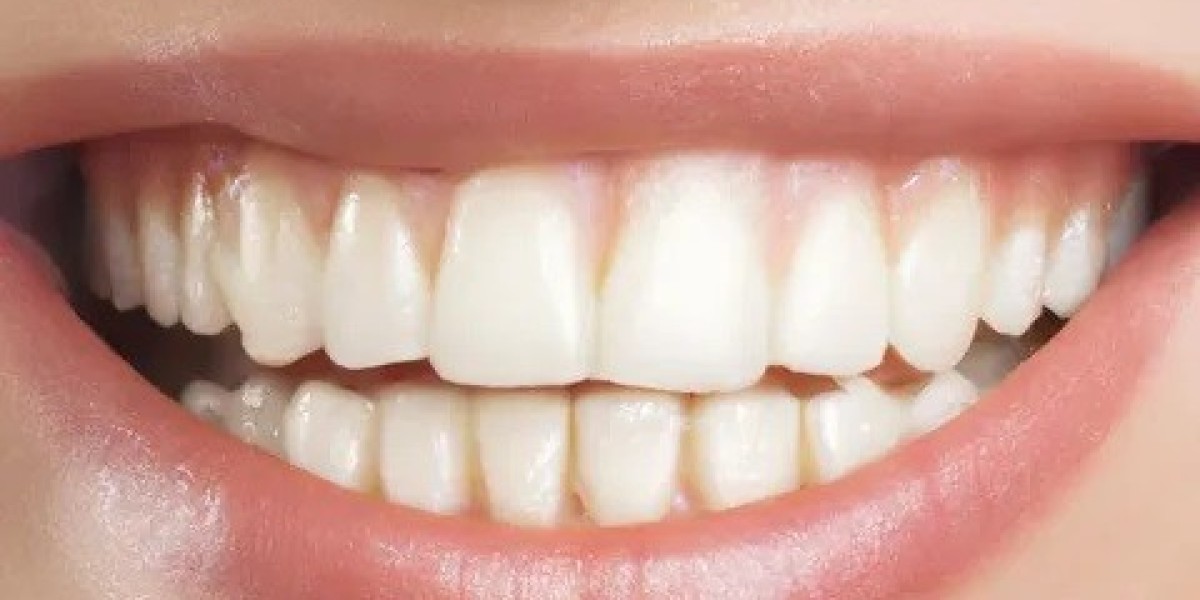 Dental Veneers in Islamabad: Before and After Transformation
