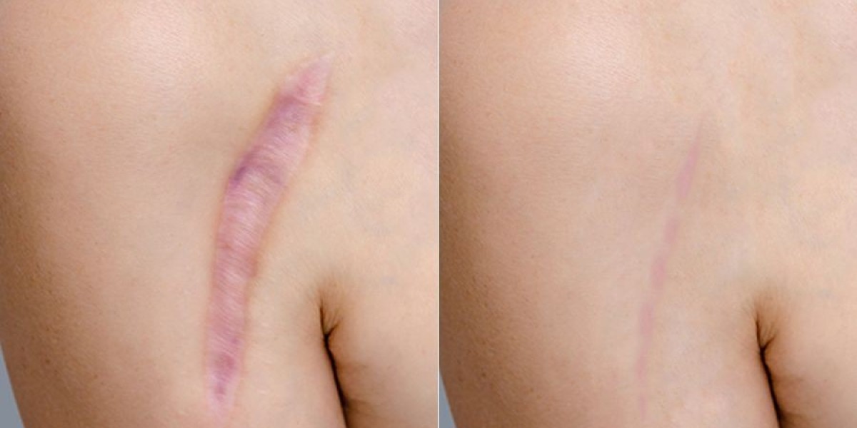 Top 5 Benefits of Laser Scar Removal in Dubai