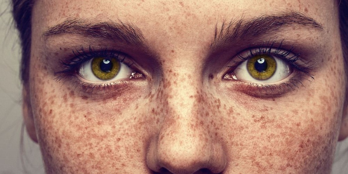 Do Freckles and Blemishes Affect Every Skin Type Equally?