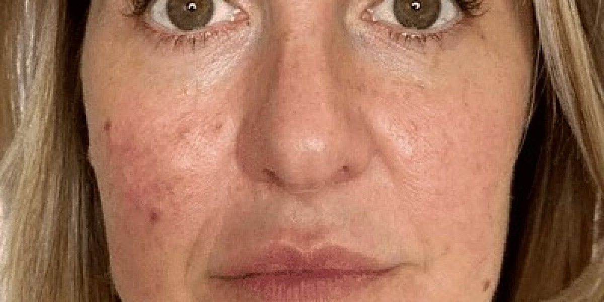 Which Pimple Treatments Work Well for Dry Skin Types?