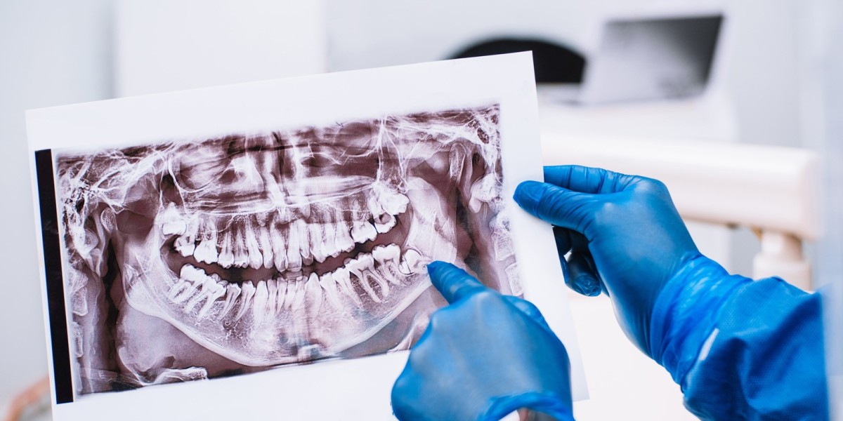 Wisdom Teeth Removal - What You Need to Know