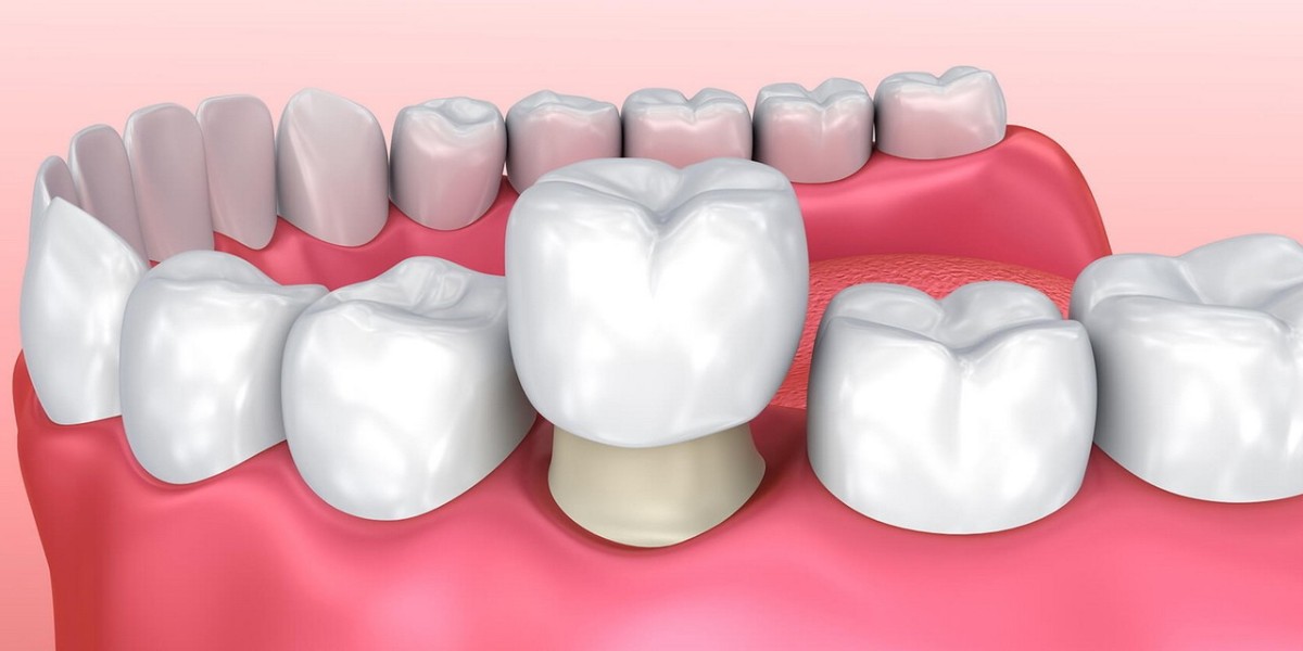 Ceramic vs. Metal Crowns: What Islamabad Dentists Recommend