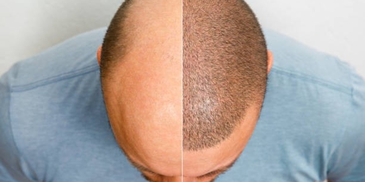 Hair Transplant in Dubai: How to Get Natural Hair Density Back
