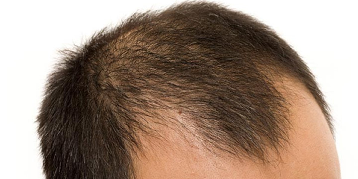 Do Hair Loss Treatments Help Increase Hair Thickness Quickly?