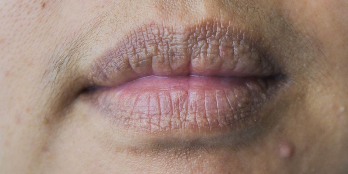 Is It Possible to Fully Remove Lip Discoloration Caused by Smoking?