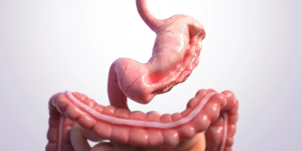 How Does Gastric Sleeve Surgery Alter Hunger Hormones?