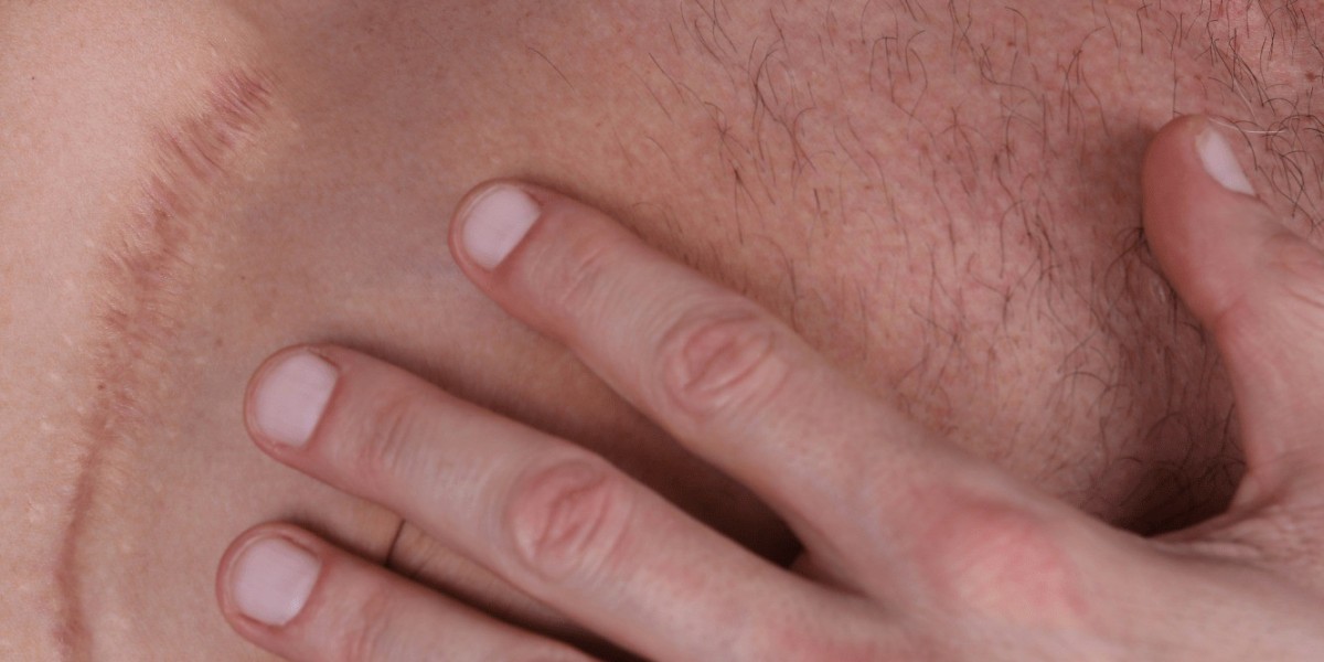 Can Laser Stretch Marks Treatment Remove Old Scars?