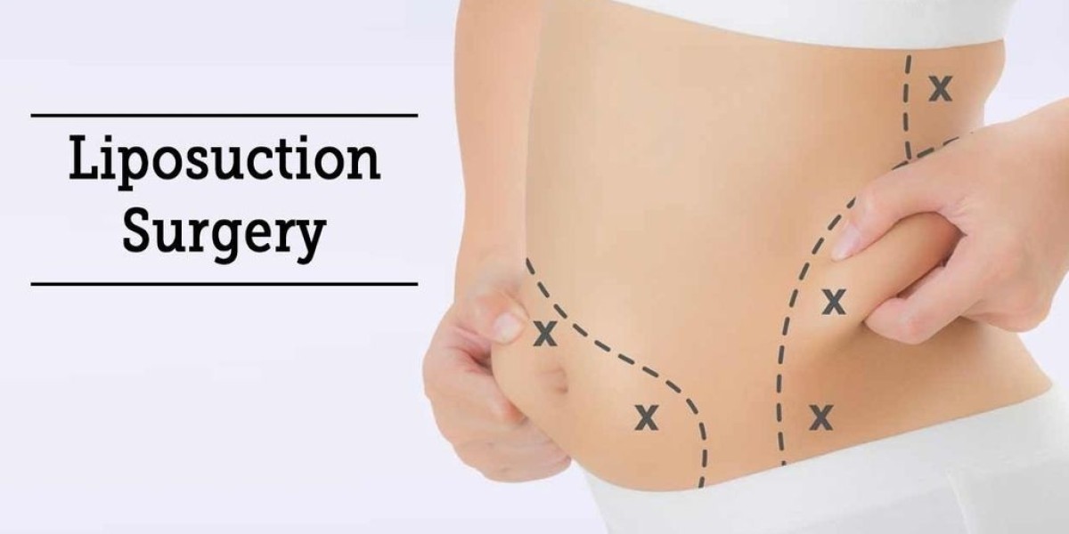 Liposuction Surgery in Dubai: Common Myths and the Truth Behind Them