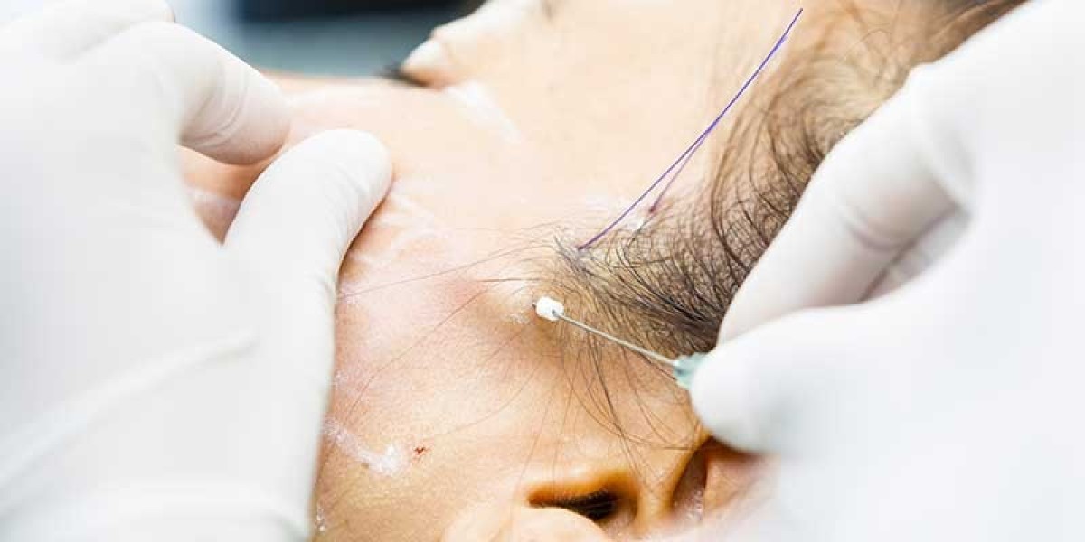 What Are the Top Benefits of Getting a Sugar Thread Lift?
