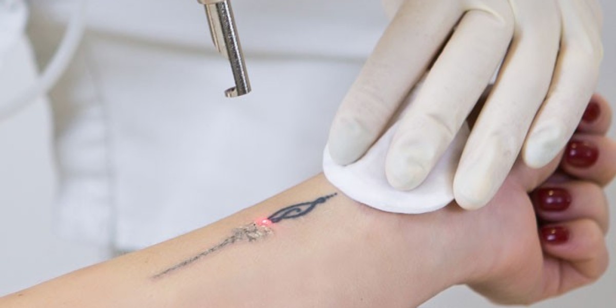 How to Achieve the Best Results from Laser Tattoo Removal