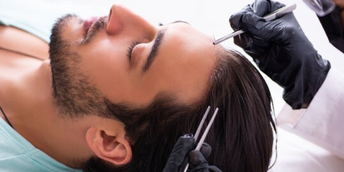 Afro Hair Transplant Istanbul – Redefining Excellence in Ethnic Hair Restoration